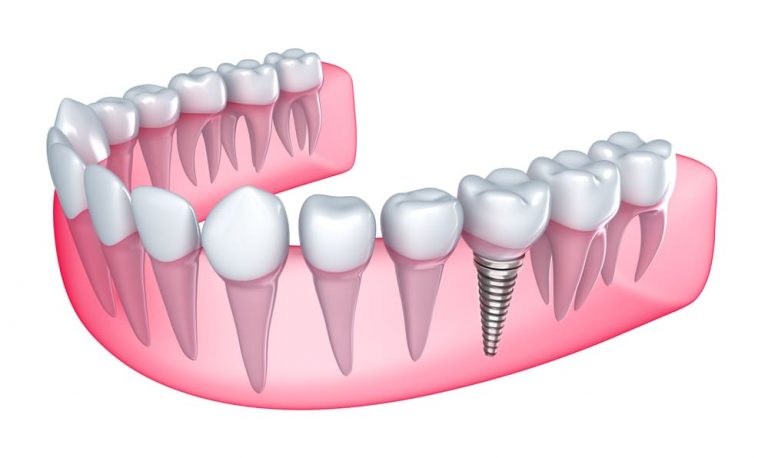 5-reasons-you-need-to-get-a-dental-implant-lmg-for-health